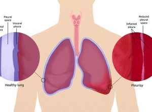 Bệnh viêm màng phổi có lây không? Lây qua những đường nào?